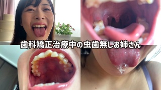 街角で声をかけて口内観察させてもらう ファーストフード店パート みおりさん